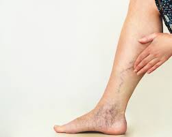 VARICES.jpeg